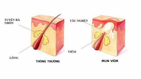 Cach_tri_tan_goc_cac_o_mun_viem_tai_tham_my_vien_lien_anh_tp_da_nang_d801391ebe0c4ca7961acaac221f2bef