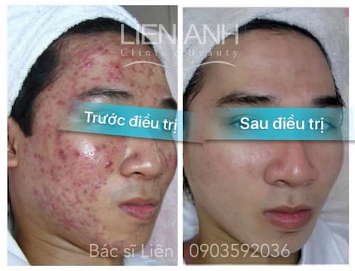 Kết quả trị mụn tại Viện thẩm mỹ Liên Anh Đà Nẵng