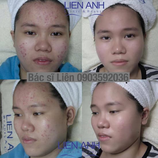 Kết quả điều trị mụn sau liệu trình thứ 4