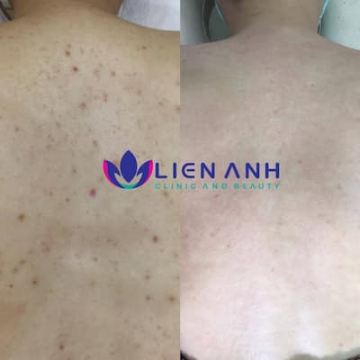 Laser trị viêm nang lông tại Đà nẵng
