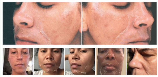 Sau_peel_da_bao_lau_thi_dung_kem_duong_qua_trinh_phuc_hoi_da_sau_pee_603e9bf700094ad095e2161276ce742c