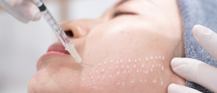 tiêm mesotherapy là gì