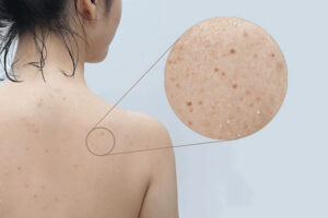 Tri_mun_lung_o_spa_gia_bao_nhieu-lieu_trinh_nhu_the_nao_36b6c2502b4f4b57a824bd1a3ba20e51