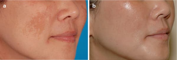 Tái tạo bề mặt bằng laser: