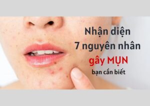 Nguyên nhân gây mụn mà bạn cần biết